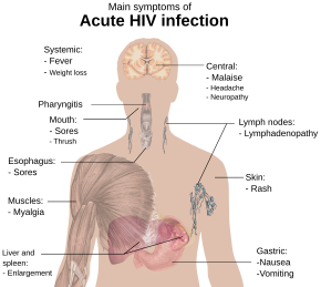 A diagram of a human torso labelled with the most common symptoms of an acute HIV infection