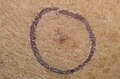 Melanoma, right posterior shoulder circled for biopsy