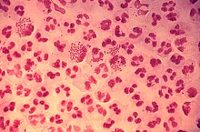 Gram-stain of gonococcal urethritis. Note distribution in neutrophils and presence of both intracellular and extracellular bacteria. (CDC)