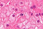 Light microscope image of an H&E-stained liver biopsy, showing "ground glass hepatocytes" associated with chronic hepatitis B infection