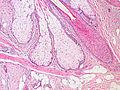 Base of pilosebaceous unit